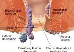 Symptoms of Hemorrhoids