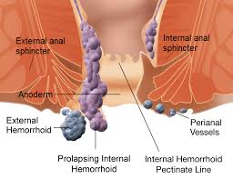  Symptoms of Hemorrhoids
